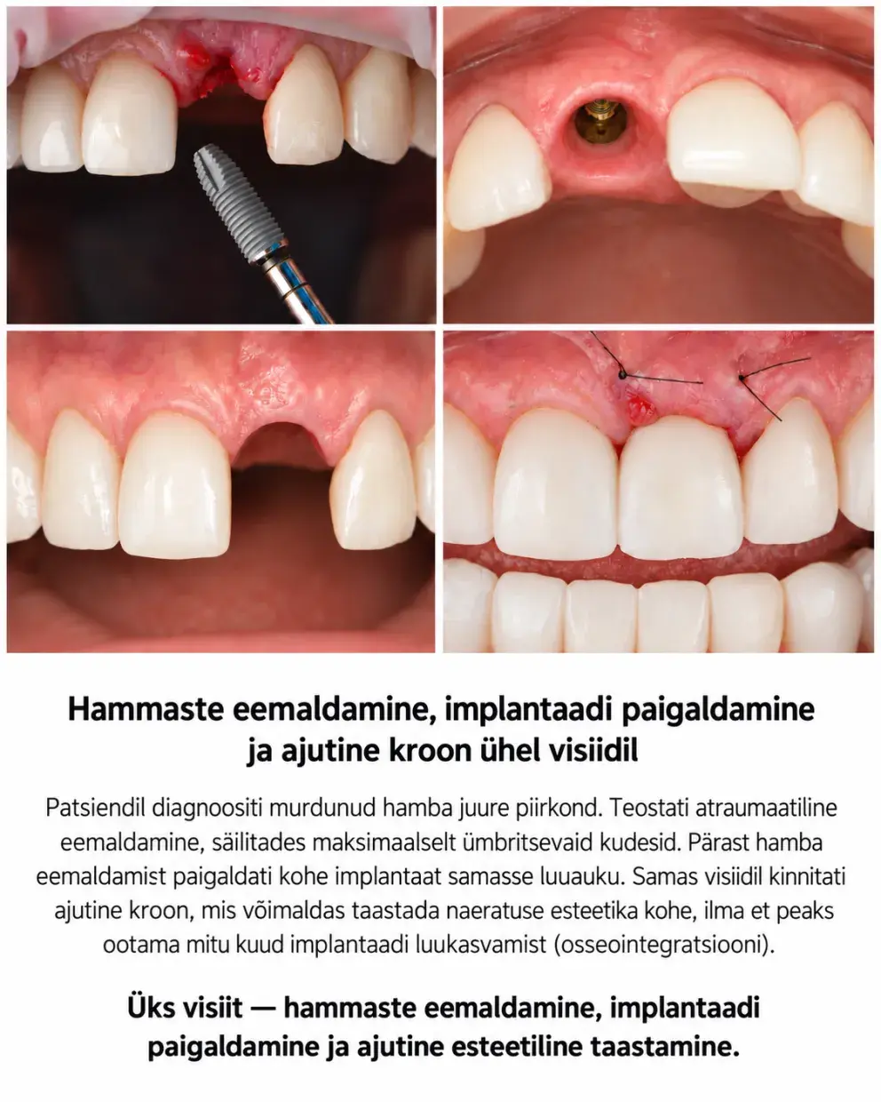 Implant est