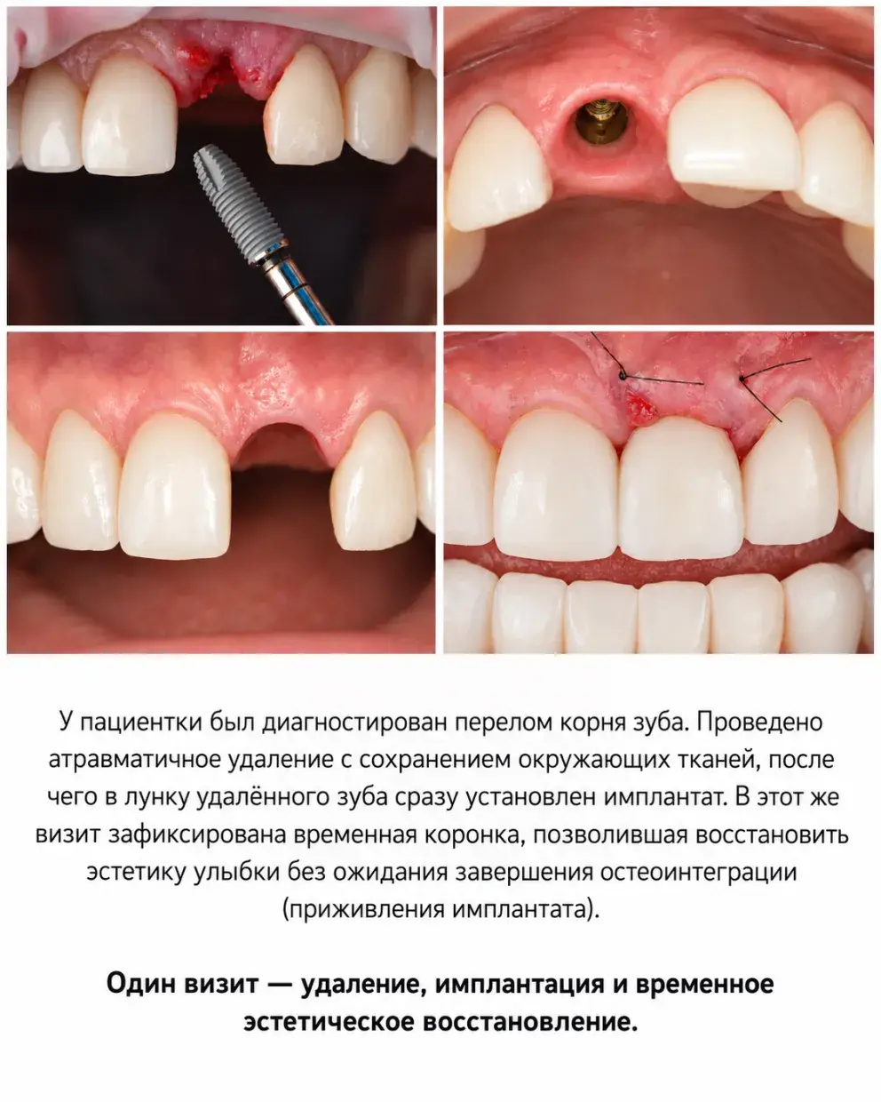 implant4